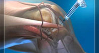 Inyección ortopédica de los productos y inyección de la rodilla del ácido hialurónico del instrumento de la puntura